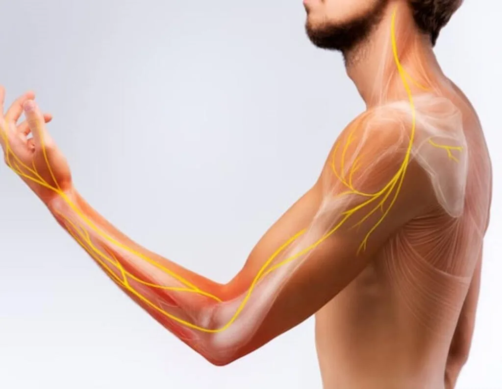 Cervical Radiculopathy