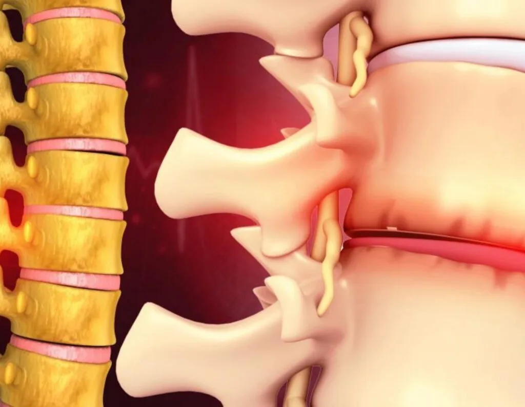 Degenerative Spine Disc Disease