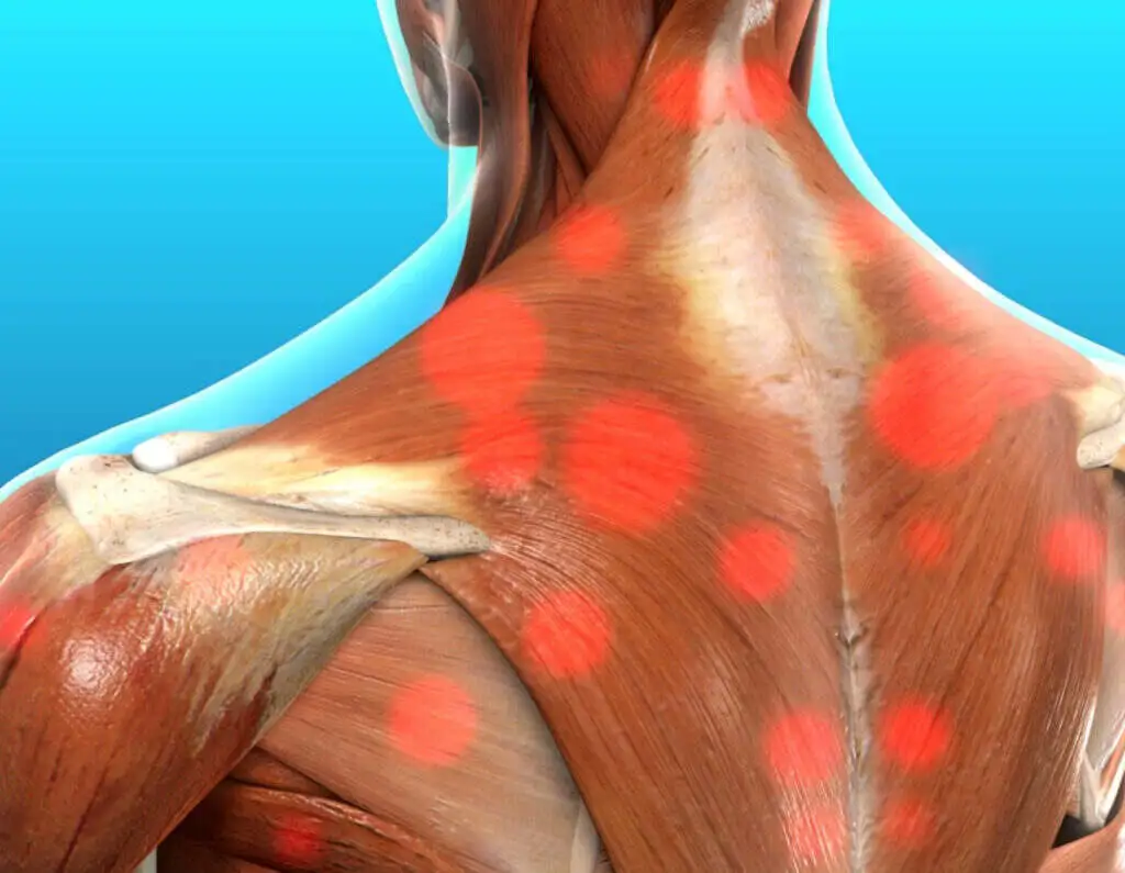 Myofascial Pain Syndrome