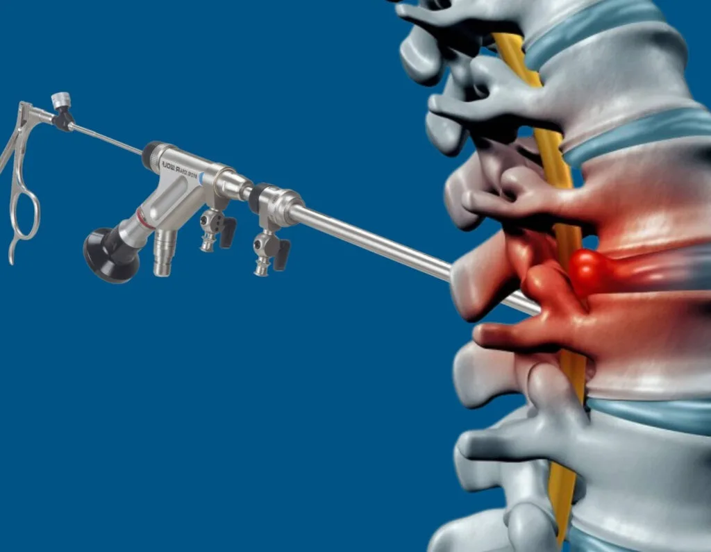 Endoscopic Discectomy
