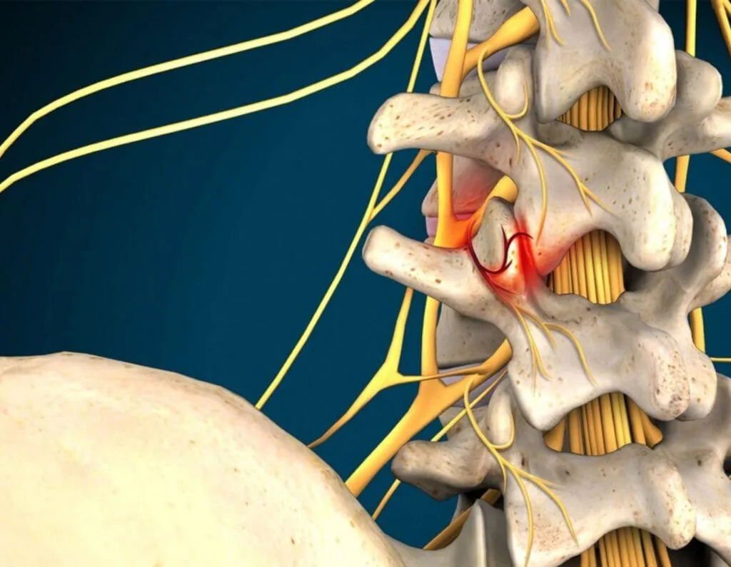 Facet Joint and Sacroiliac Joint Arthritis Problem