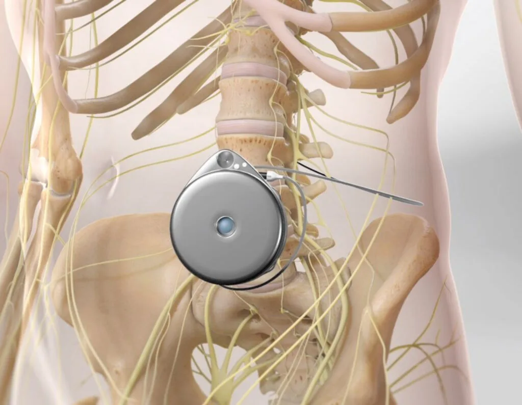 Intrathecal Drug Delivery System
