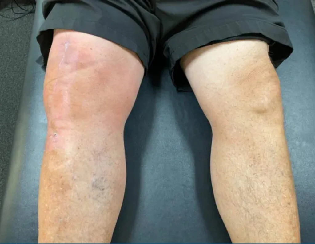 Joint Ligament Partial Tear and Edema