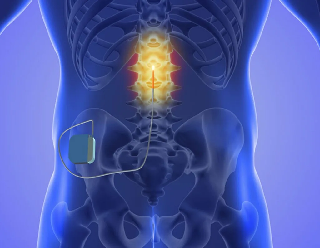 Neuromodulation Therapy