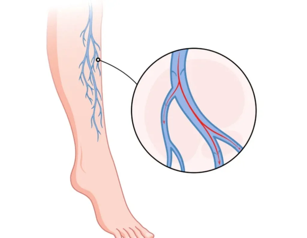 Peripheral Vascular Disease Pain