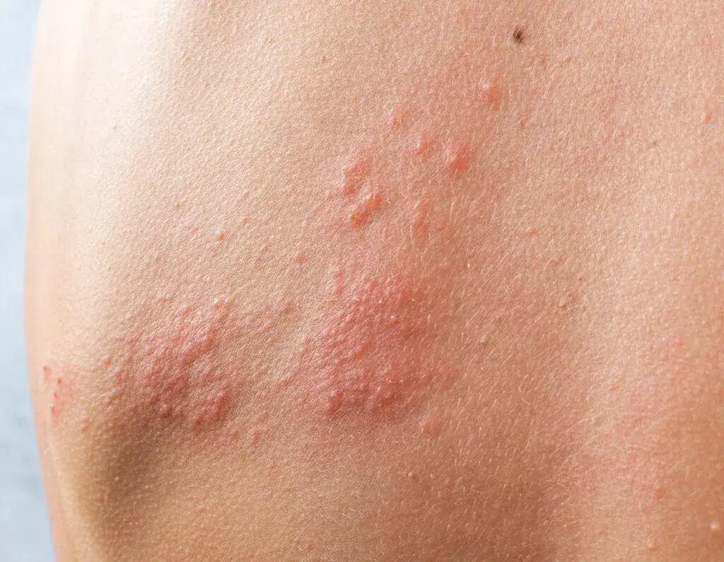 chronic nerve pain condition