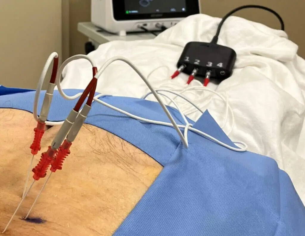 minimally invasive pain treatment