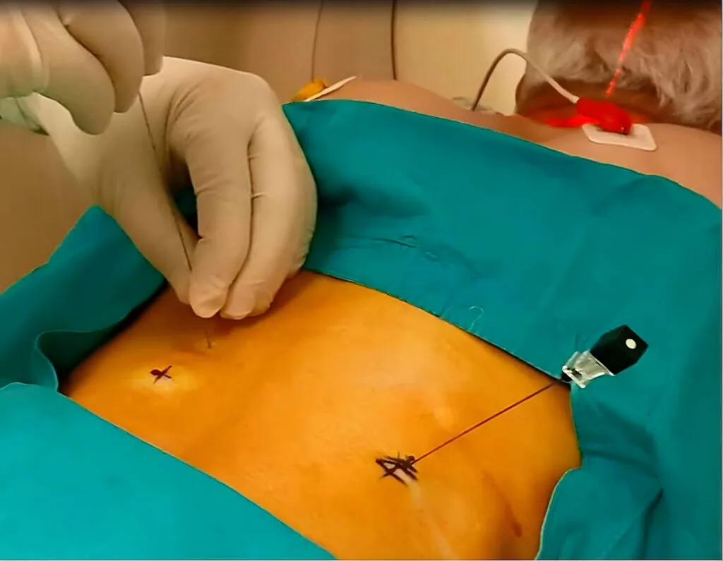 Selective Nerve Blocks for Cancer Pain Relief