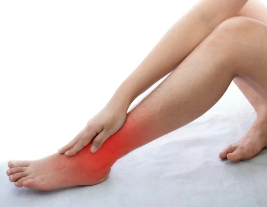 What is Complex Regional Pain Syndrome